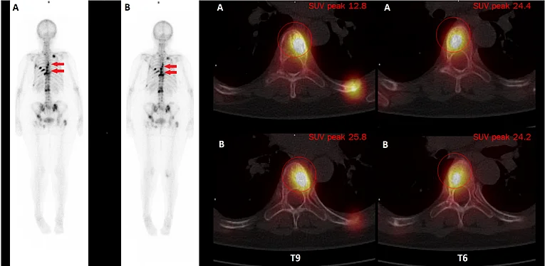 Longitudinal changes in Bone Metabolism