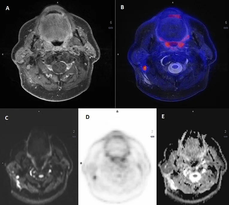 Lymphknotenmetastase HNSCC PET/MR