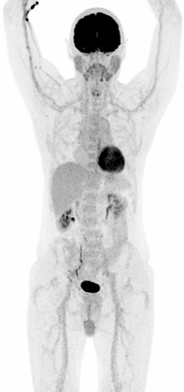 Maximumintensitätsprojektion (MIP) einer unauffälligen F-18-FDG PET mit physiologischer Verteilung des radioaktiven Traubenzucker. Es zeigt sich eine kräftige Nuklidspeicherung im Gehirn und Herz. Zusätzlich ist die Ausscheidung über die Nieren zu erkennen